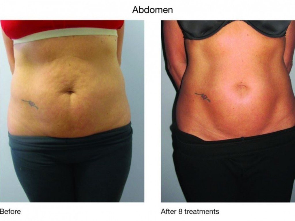 CoolSculpting in Lubbock, TX - American Laser Med Spa. Visit us