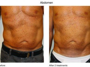 CoolSculpting in Lubbock, TX - American Laser Med Spa. Visit us today for a  consultation and experience our T2T treatment