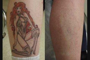 Laser Tattoo Removal, Laser Tattoo Removal