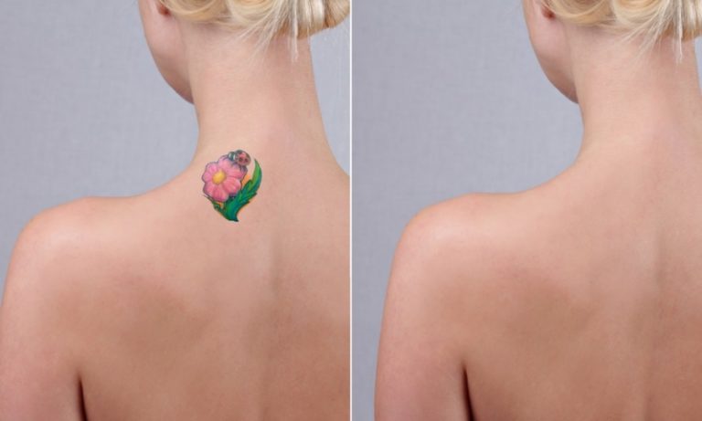 Laser Tattoo Removal How Many Sessions Does It Take? Paradise Med